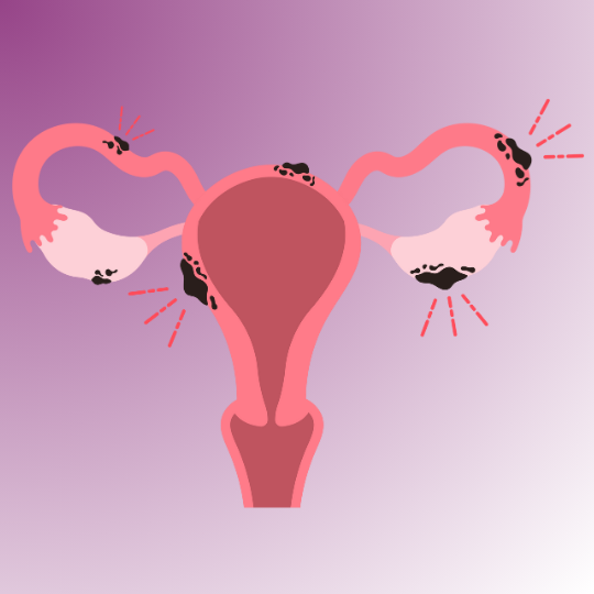 Endometriosis Management